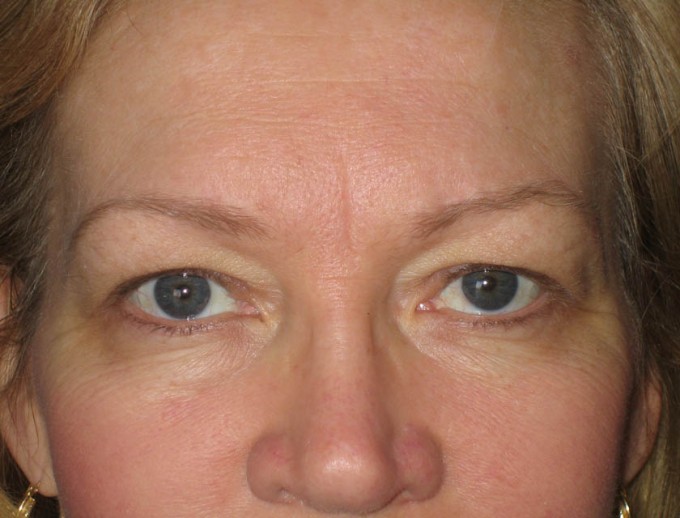 Eyebrows (before)