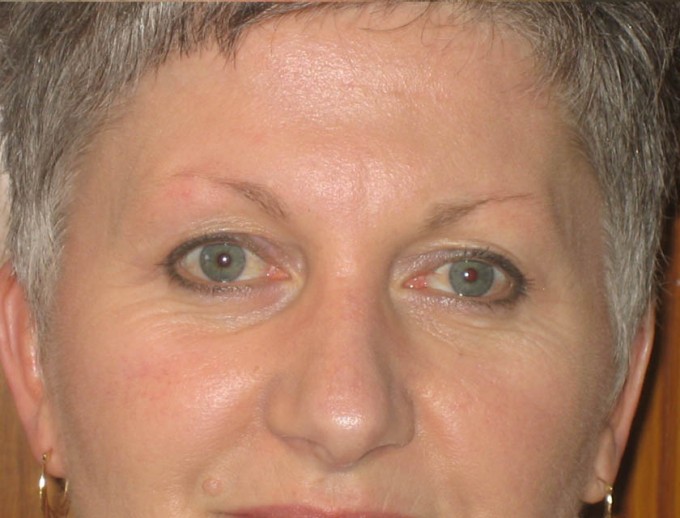 Eyebrows (before)